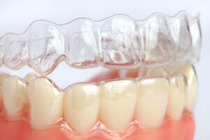 invisalign dental care patients
