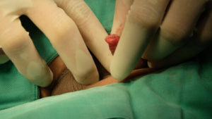 paraphimosis treatment from home