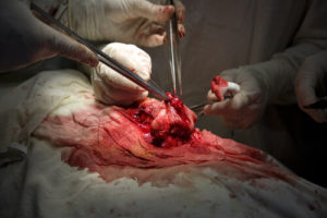 urinary diversion types