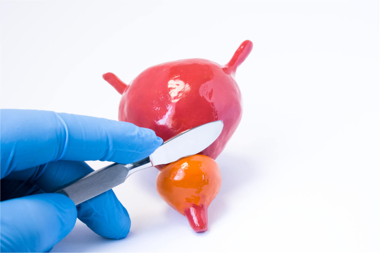 Urinary Diversion Types