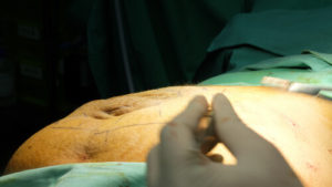 laparoscopic hernia surgery