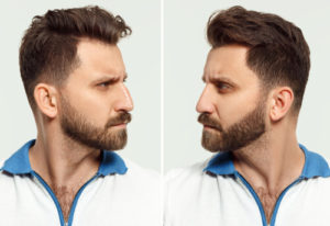 nose job before and after male results