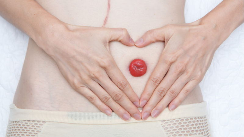 Itchy Stitches After An Ostomy: What Does This Mean?