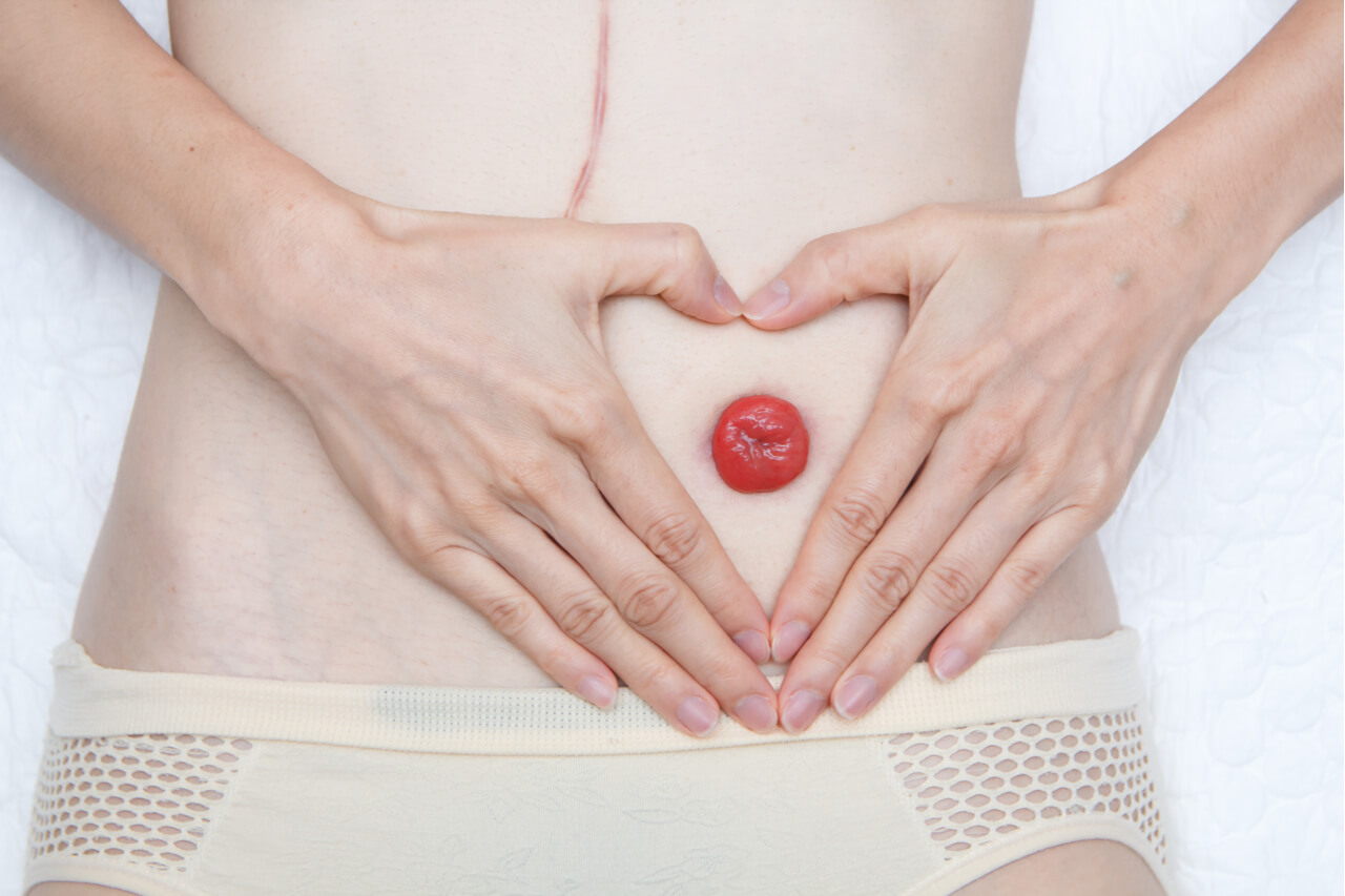 Itchy Stitches After An Ostomy: What Does This Mean?